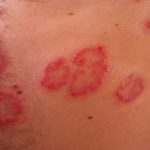 Erupciones por dermatitis en el cuerpo