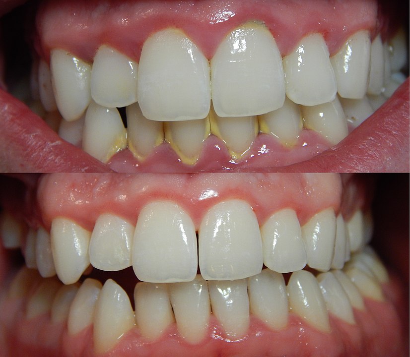 Dientes antes y después de recibir tratamiento para la gingivitis