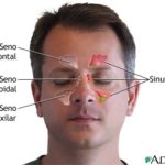 Partes de las vias nasales afectadas por la sinusitis