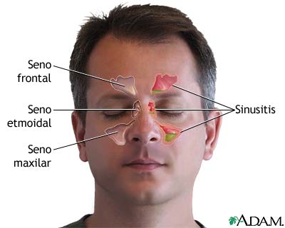 Partes de las vias nasales afectadas por la sinusitis